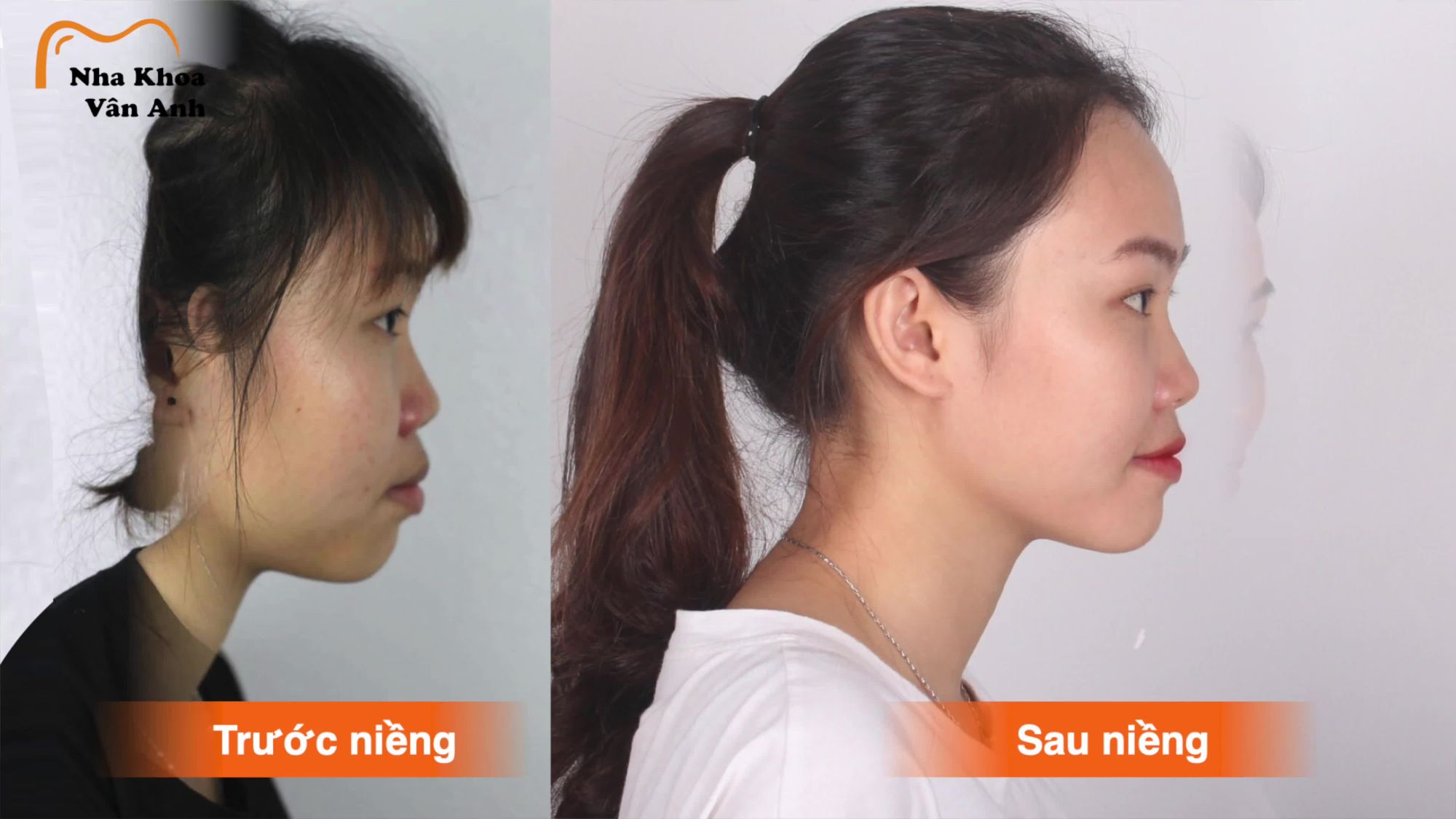 TRƯỚC KHI NIỀNG RĂNG, EM RẤT ÍT CƯỜI, HẦU NHƯ LÀ KHÔNG CƯỜI!