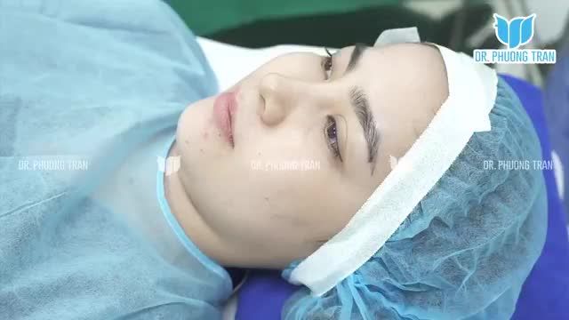 Bật cao đầu mũi, nâng sống mũi tự nhiên và bọc chóp mũi bằng sụn tai