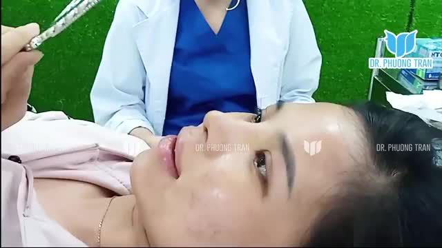 CẬN CẢNH MŨI CẤU TRÚC SỤN SƯỜN SAU 5 NGÀY PHẪU THUẬT