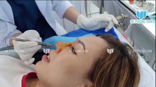 CẬN CẢNH MŨI CẤU TRÚC SURGIFORM SAU 7 NGÀY PHẪU THUẬT
