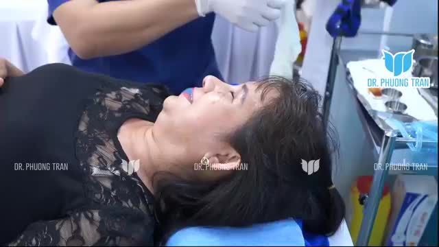 CHỊ KHÁCH 50 TUỔI ĐI NÂNG MŨI VÀ CÁI KẾT