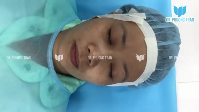 CHUẨN BỊ NÂNG MŨI CHO MỘT KHÁCH HÀNG CÓ SỐNG MŨI GÃY, ĐẦU MŨI NGẮN BẰNG PHƯƠNG PHÁP CẤU TRÚC SỤN SƯỜN