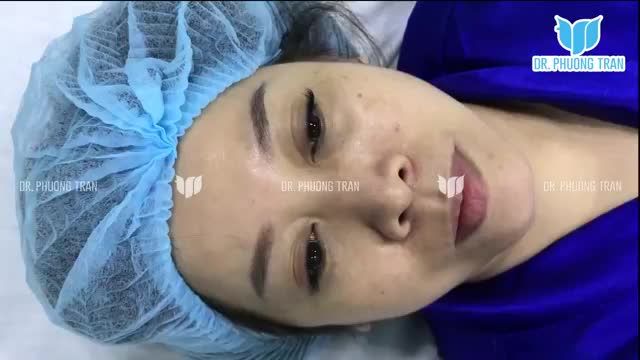 CHUẨN BỊ PHẪU THUẬT NÂNG MŨI SỤN SƯỜN VÀ XỬ LÝ DA DƯ MÍ MẮT TRÊN (P1)