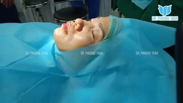 Khắc phục đầu mũi to củ hành bằng nâng mũi cấu trúc