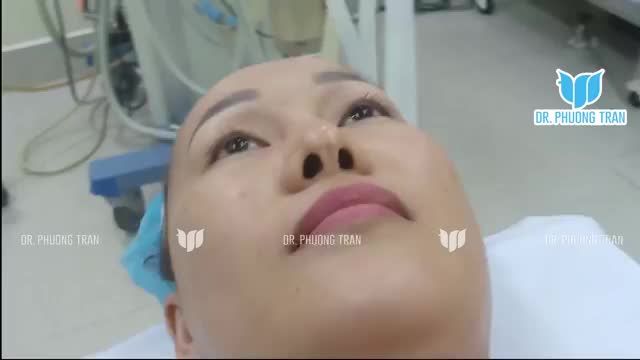 KHẮC PHỤC MŨI ĐÃ SỬA ĐI SỬA LẠI NHIỀU LẦN, ĐẦU MŨI BỊ MÔ SẸO, VÁCH NGĂN YẾU