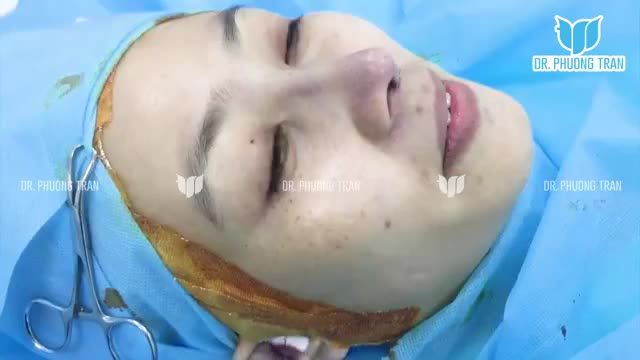 KHÁCH HÀNG GẦN NHƯ "LỘT XÁC" NGAY SAU PHẪU THUẬT NÂNG MŨI CẤU TRÚC SỤN SƯỜN