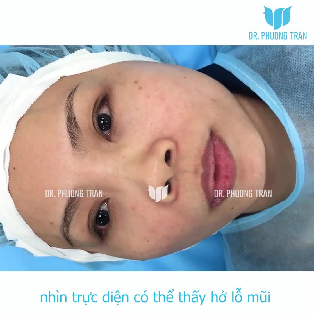 KHÁCH HÀNG MŨI NGẮN, THẤP TẸT "LỘT XÁC" NGOẠN MỤC SAU 60 PHÚT NÂNG MŨI CẤU TRÚC