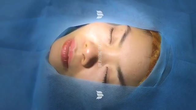 CÁC BẠN CÓ MUỐN BIẾT MỘT CA NÂNG MŨI CẤU TRÚC SURGIFORM ĐƯỢC THỰC HIỆN THẾ NÀO KHÔNG?