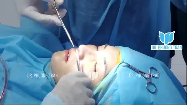 NÂNG MŨI CẤU TRÚC CHO BẠN KHÁCH HÀNG ĐÃ SỬA MŨI HỎNG 2 LẦN