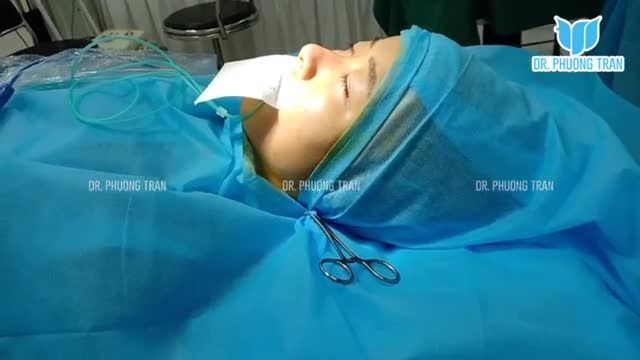 NÂNG MŨI CẤU TRÚC SURGIFORM KHẮC PHỤC MŨI GÃY, NGẮN