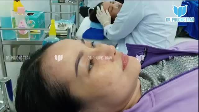 Nâng mũi đặt sống Surgiform. Cận cảnh dáng mũi ngay sau tháo nẹp.