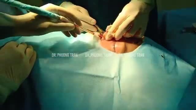 Nâng mũi sụn sườn khắc phục mũi lệch sống, lung lay; đầu mũi ngắn hếch (P1)