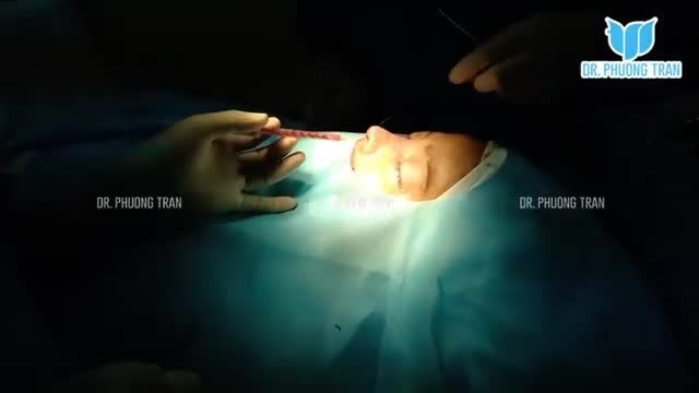 Nâng mũi sụn sườn khắc phục mũi lệch sống, lung lay; đầu mũi ngắn hếch (P2)