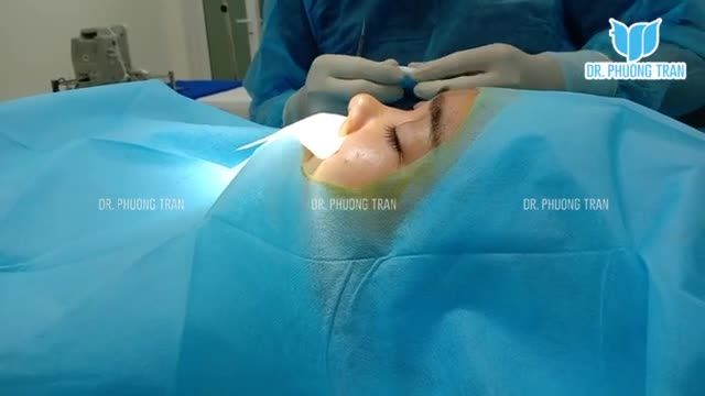 Phẫu thuật nâng sống mũi rất nhanh chỉ 15 - 20 phút là xong (P1)