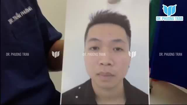 PHẪU THUẬT TẠO HÌNH MŨI CẤU TRÚC CHO NAM CÓ GÌ ĐẶC BIỆT?