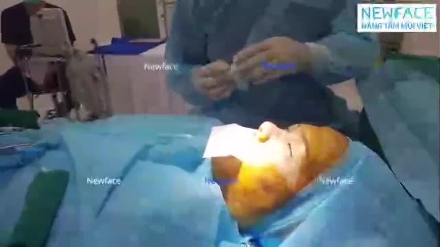 Toàn bộ một ca nâng mũi cấu trúc Surgiform