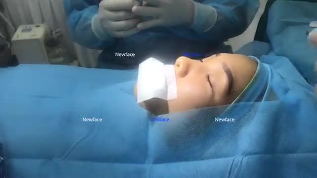Video ca nâng mũi đặt sống Surgiform