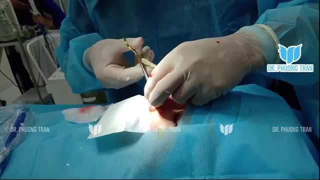 XỬ LÝ TRƯỜNG HỢP SỐNG MŨI THẤP GẦN NHƯ KHÔNG CÓ, ĐẦU MŨI BÈ