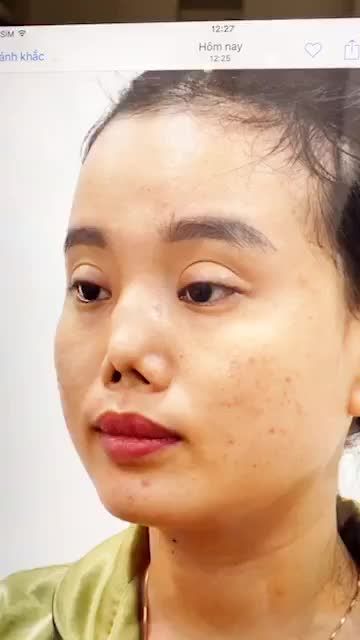 Chia sẻ của cô gái 4 lần sửa mũi hỏng đến mức phải điều trị tâm lý