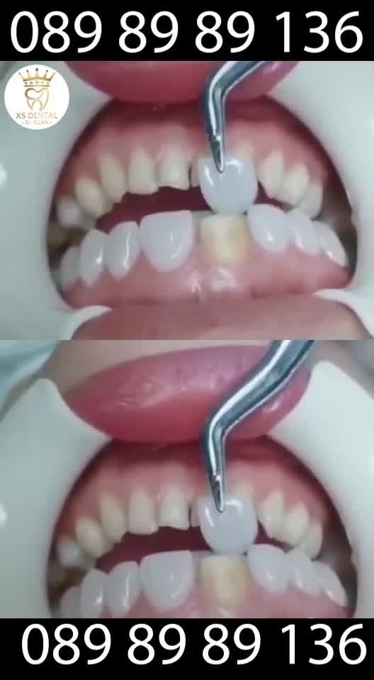 Dán Sứ Veneer Siêu mỏng - Siêu đẹp tại  XS DENTAL
