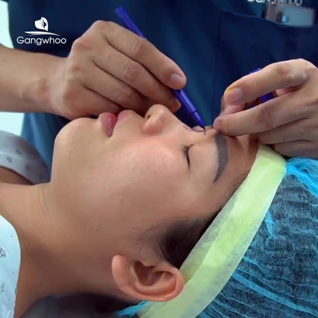 ĐÓN DIỆN MẠO MỚI VỚI COMBO NÂNG MŨI NANOFORM VÀ THU GỌN CÁNH MŨI