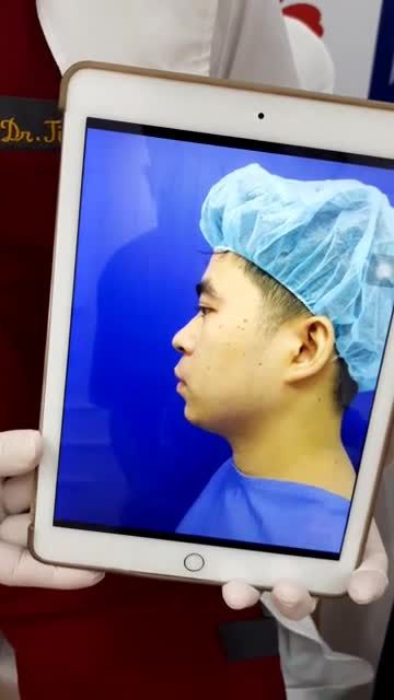 Gương mặt "chuẩn" soái ca nhờ combo dịch vụ trượt hàm trên dưới tại bệnh viện thẩm mỹ Kangnam - 30 ngày sau phẫu thuật