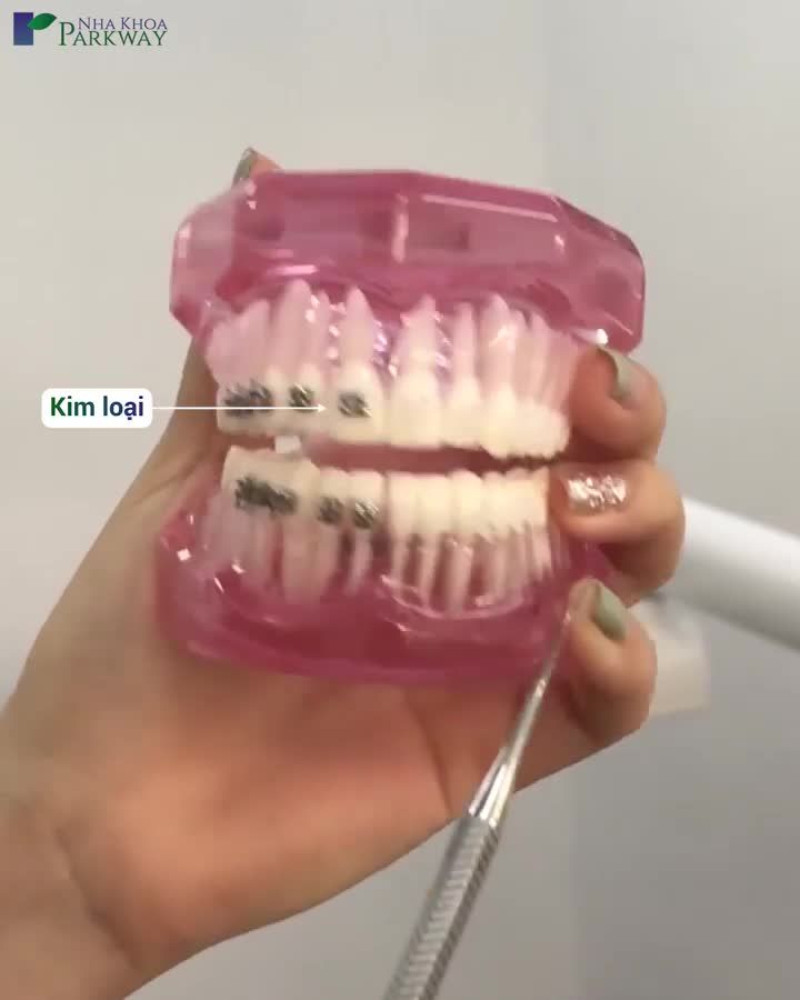 NIỀNG RĂNG HIỆU QUẢ, KHÔNG LỘ VỚI MẮC CÀI SỨ THẨM MỸ