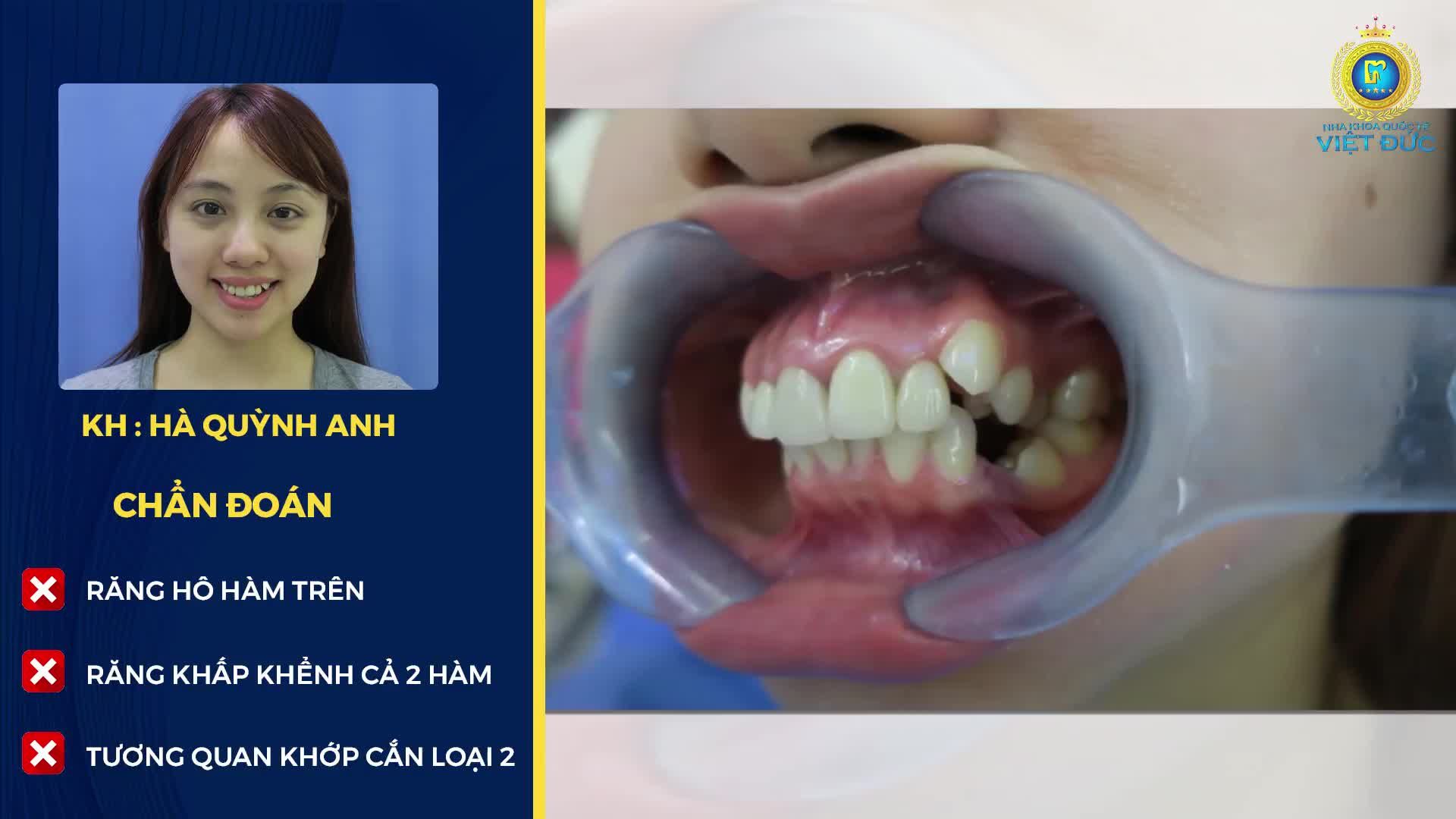 RĂNG ĐỀU MẶT XINH CHỈ SAU NIỀNG RĂNG BẰNG CÔNG NGHỆ SỐ 1 THẾ GIỚI