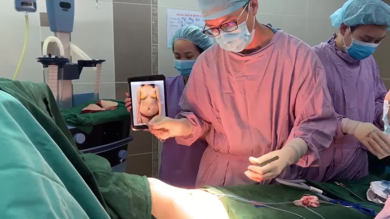 TÁI TẠO VÒNG 2 CON KIẾN SAU SINH NHỜ VASER LIPO KẾT HỢP TẠO HÌNH THÀNH BỤNG CÓ CHUYỂN RỐN