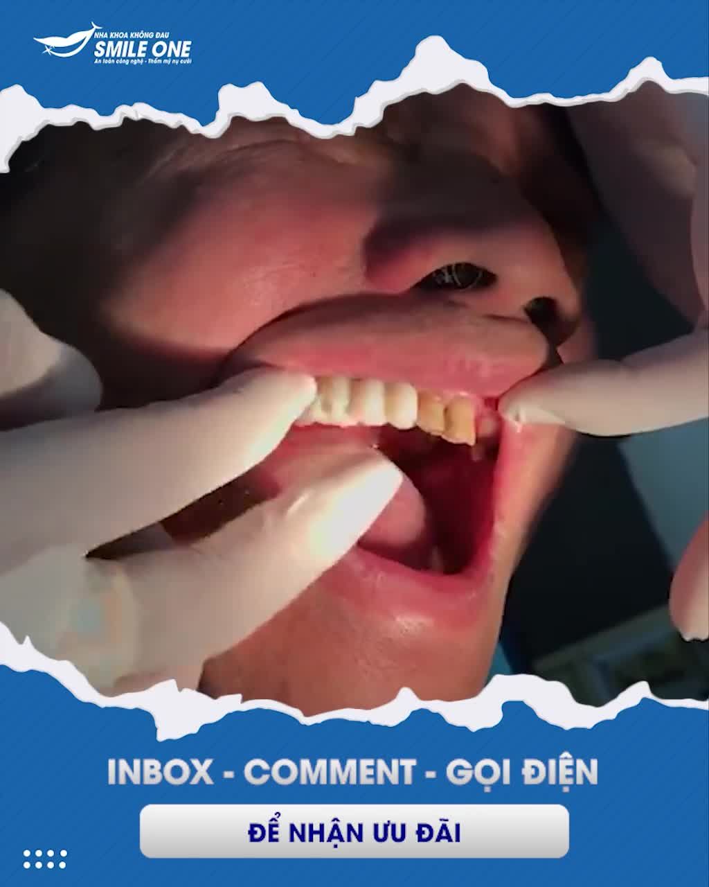 MẤT RĂNG LÂU NĂM PHẢI LÀM SAO? CÓ THỂ PHỤC HỒI HAY KHÔNG?