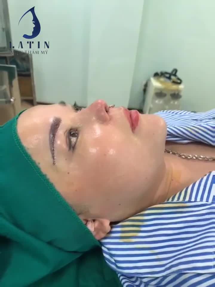 NÂNG CUNG MÀY ĐA TẦNG  MŨI SỬA LẠI SIÊU CẤU TRÚC LẦN 3