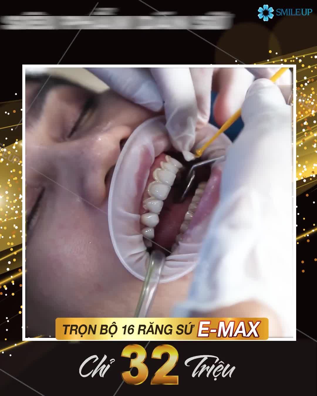 SIÊU PHẨM DÁN SỨ VENEER EMAX DẪN ĐẦU XU HƯỚNG