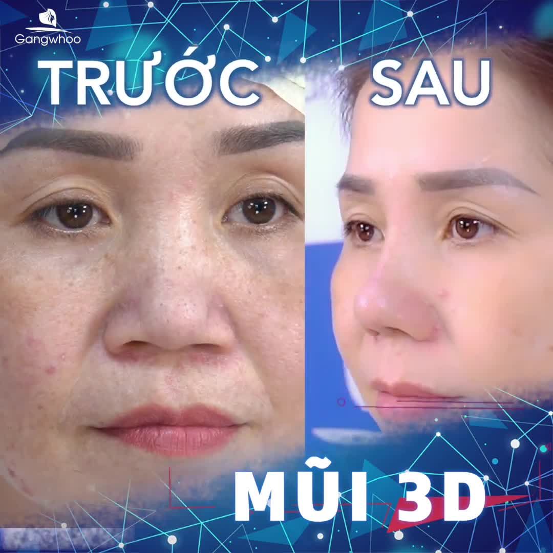 THĂNG HẠNG NHAN SẮC - THAY ĐỔI PHONG THỦY VỚI NÂNG MŨI CẤU TRÚC 3D