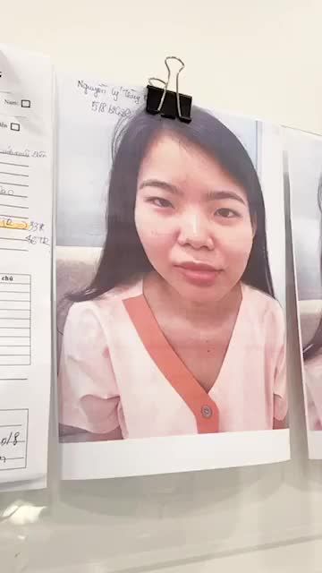 XEM DÁNG MŨI TRƯỚC KHI ĐÓNG VẾT KHÂU