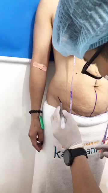 Thoát BỤNG MỠ NGỰC MƯỚP đổi lại Eo Thon - Ngực căng tròn ngay tại Kangnam
