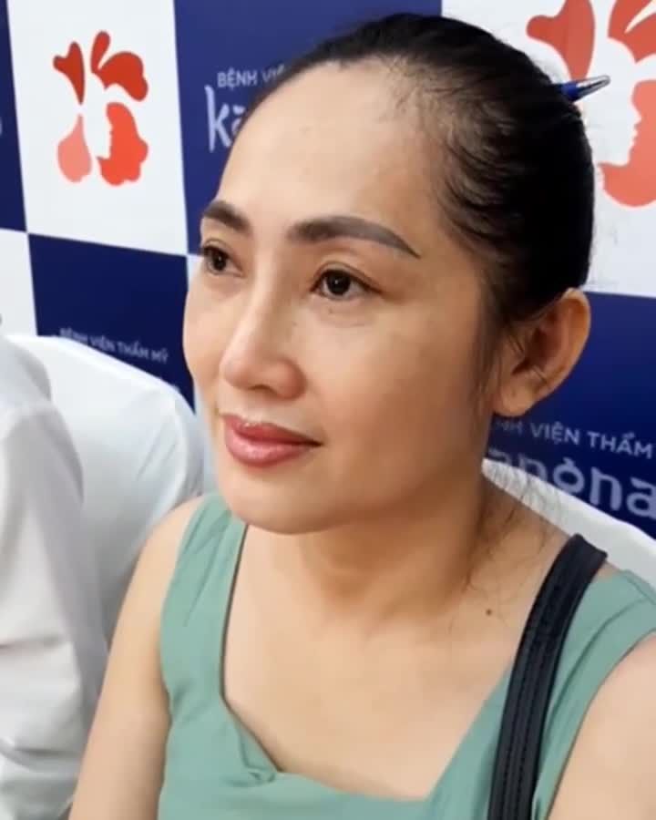 Kết quả MŨI vào dáng SIÊU TỰ NHIÊN