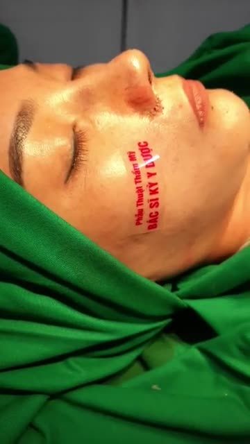 NÂNG MŨI BÁN CẤU TRÚC CUỘN CÁNH MŨI PLASMA