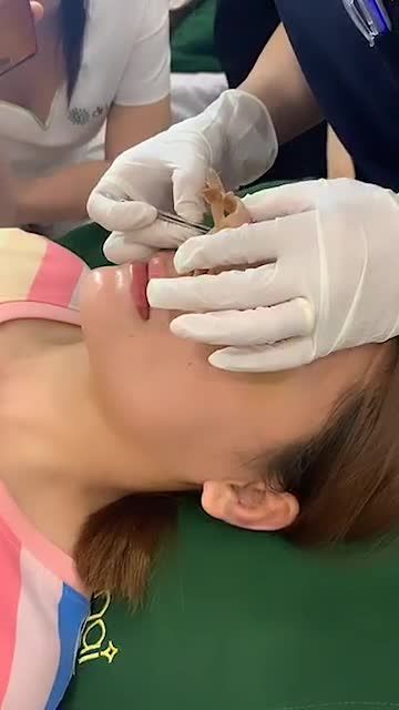 Siêu phẩm mũi đẹp chỉ sau 5 ngày bên Bs Đỗ Quang Khải đây, khoe lên để cả nhà mình chiêm ngưỡng nha!