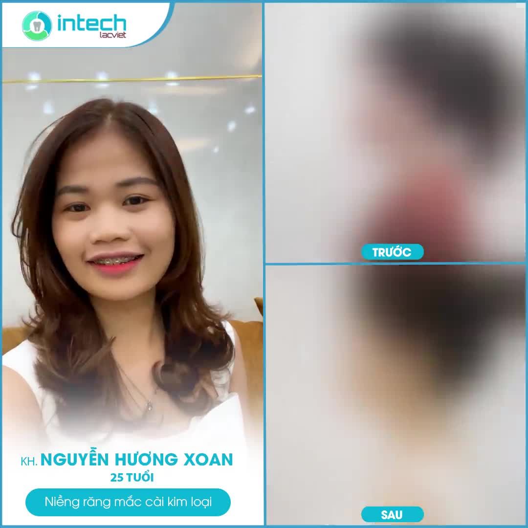 SỰ THAY ĐỔI NGOẠN MỤC CỦA CÔ GÁI NHỎ NHẮN NGUYỄN HƯƠNG XOAN SAU KHI NIỀNG RĂNG