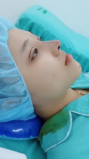 XINH LUNG LINH KHI KẾT HỢP DỊCH VỤ BẤM MÍ VÀ NÂNG MŨI CẤU TRÚC FASCIA TẠI SAIGON VENUS