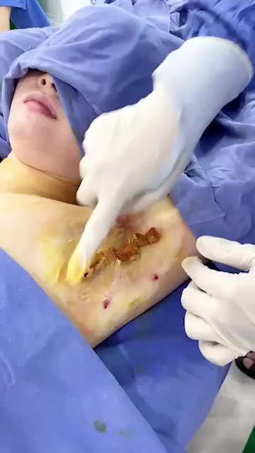 Ai bảo hút tuyến mồ hôi là phải phẫu thuật, là để lại sẹo?