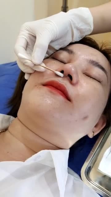 Quy trình cắt chỉ mũi sau nâng 10 ngày nâng mũi tại Kanngam