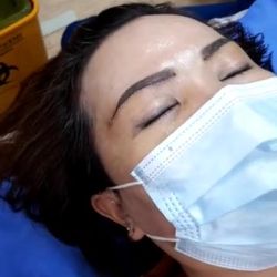 Quy trình cắt chỉ cho khách hàng Nâng cung chân mày tại Bệnh viện thẩm mỹ kangnam