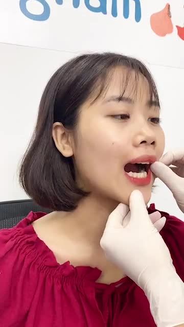 "Lột xác" không ngờ sau phẫu thuật chỉnh hàm móm.