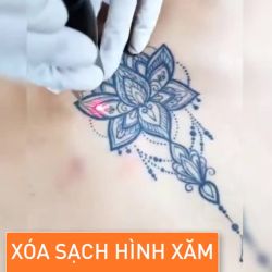 Bay màu mực xăm, không để lại sẹo với công nghệ xóa xăm đỉnh cao Laser Picosure