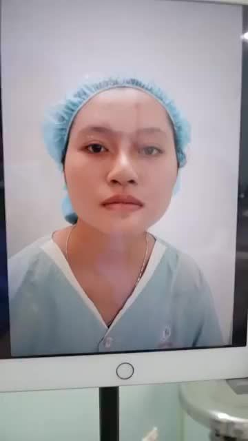 60P - ĐỔI MŨI XẤU THÀNH MŨI XINH