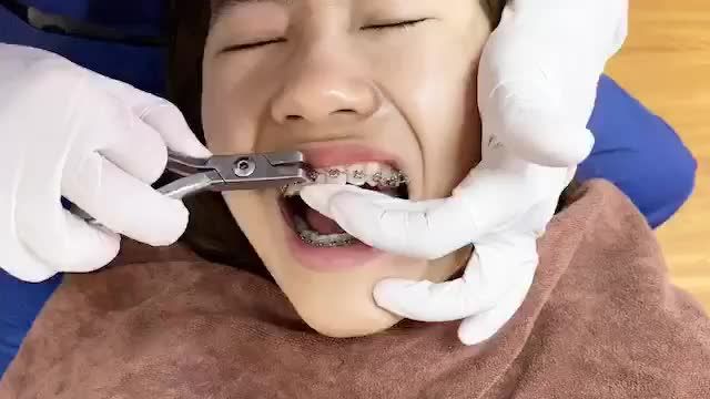 BUNG LỤA CHO KHÁCH HÀNG SAU NIỀNG RĂNG HÔ