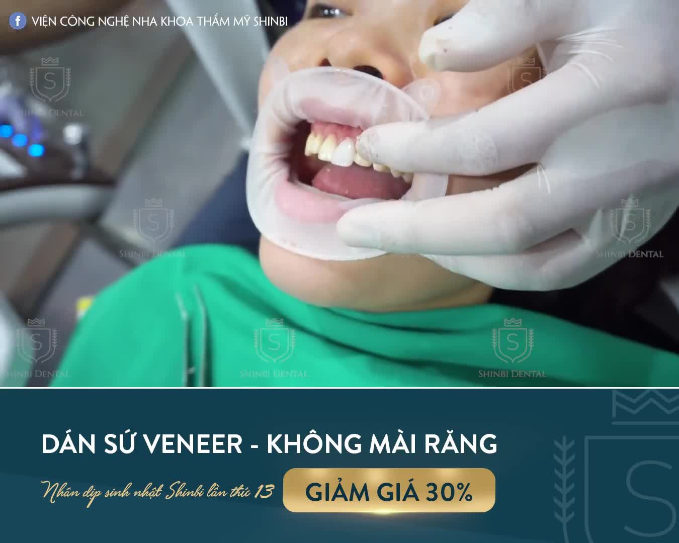 CASE DÁN 20 RĂNG SỨ VENEER SIÊU MỎNG TUYỆT ĐẸP
