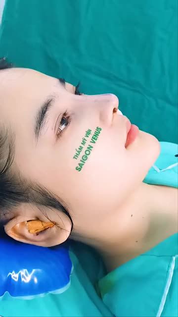 CẤU TRÚC FASCIA DÁNG MŨI ĐANG HOT TẠI SAIGONVENUS