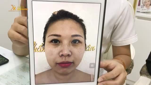 KHÁCH HÀNG THỰC HIỆN COMBO TRỊ TÀN NHANG + HÚT MỰC XĂM MÍ TẠI TMV XUÂN HƯƠNG
